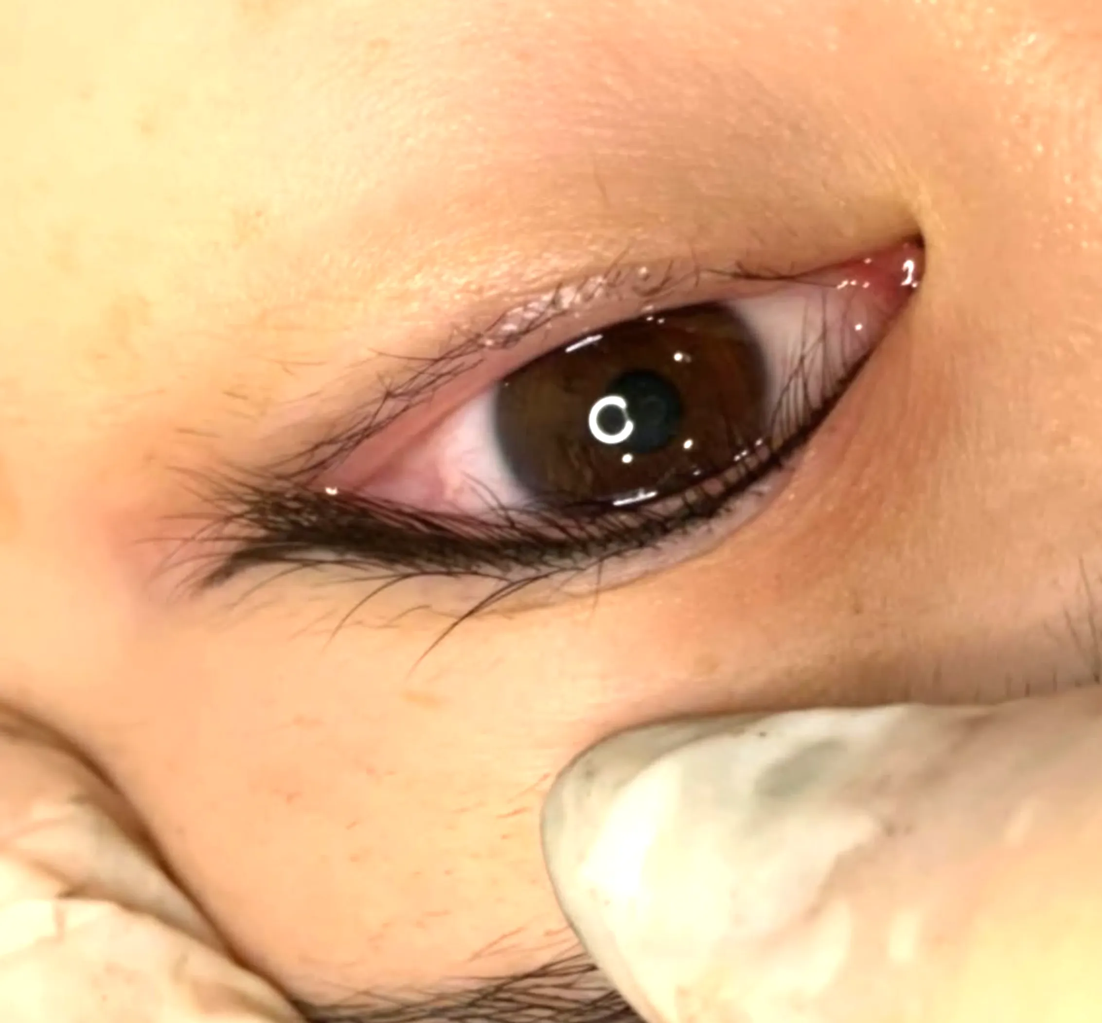 lash follicle damage